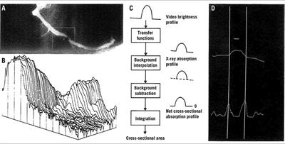 Coronary angiography: a review of the state of the art and the evolution of angiography in cardio therapeutics